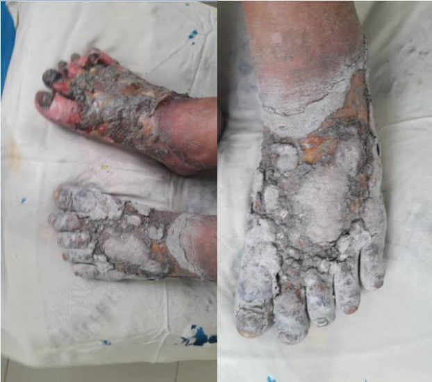   Nhiều bệnh nhân đái tháo đường ngâm chân với các loại lá có thể dẫn tới viêm loét, nhiễm trùng bàn chân…  