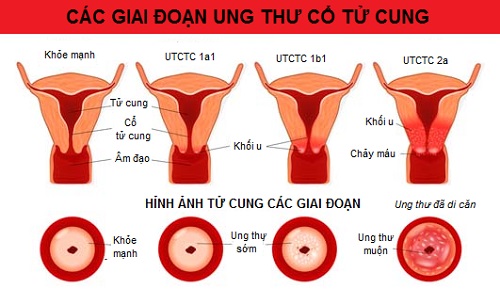   Phụ nữ hường xuyên viêm nhiễm tại bộ phận sinh dục dưới, trong đó có viêm lộ tuyến cổ tử cung lâu ngày không chữa có nguy cơ cao mắc ung thư cổ tử cung. Ảnh minh họa  