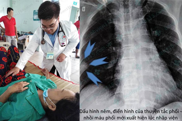   Bệnh nhân bị thuyên tắc phổi đang được điều trị tại bệnh viện  
