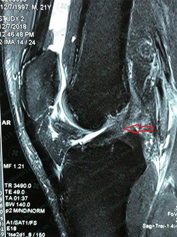   Hình ảnh MRI khớp gối phải của bệnh nhân cho thấy dây chằng chéo trước đứt hoàn toàn  