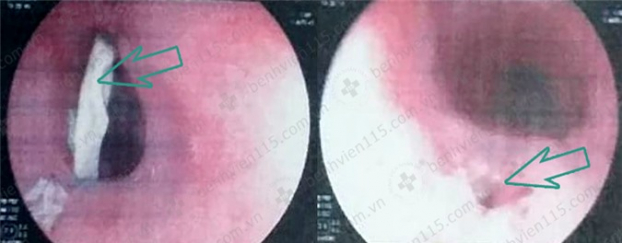   Hình ảnh nội soi thực quản của bệnh nhân: mảnh xương gà (trái) và lỗ thủng thực quản sau khi gắp xương gà ra (phải)  