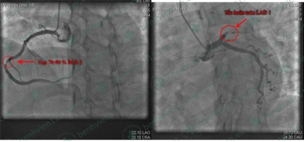   Hình ảnh chụp vành tim của bệnh nhân  