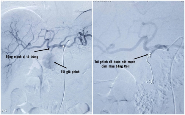   Hình ảnh túi giả phình động mạch vị tá tràng trước và sau khi được can thiệp nút mạch cầm máu  