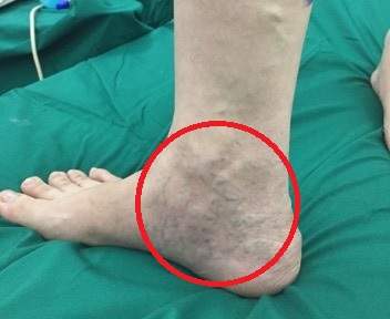   Chân bệnh nhân H. nổi đầy gân xanh ngoằn ngoèo nhìn ghê rơn  