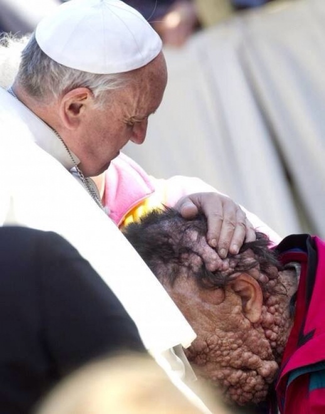Đức Giáo hoàng ôm một người mắc bệnh u sợi thần kinh