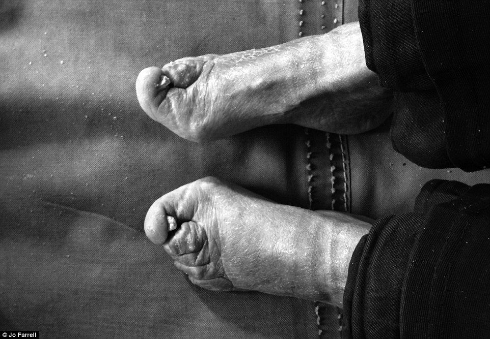   Đôi chân của bà Hoàng Xuân Hồng, bà chia sẻ rằng mẹ bà đã bắt bà phải bó chân từ khi còn nhỏ xíu  