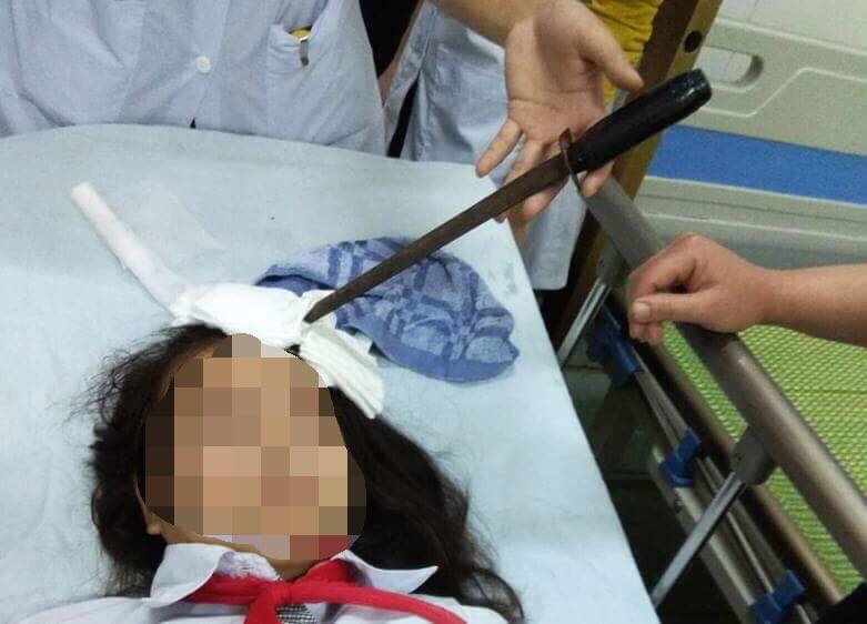 Nữ sinh bị bạn học cùng trường phi dao vào trán được đưa đi cấp cứu khi con dao vẫn cắm chặt trên trán. Ảnh: Báo Hà Nam