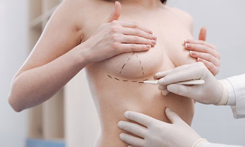 Hàng trăm phụ nữ Mỹ bị ung thư máu do nâng ngực 0