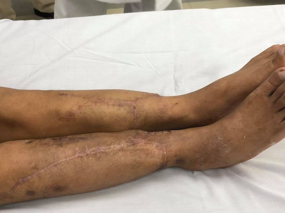    Đôi chân của bệnh nhân sau khi được phẫu thuật.  