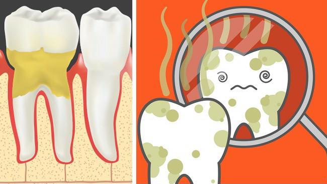 Hôi miệng khiến bạn tư ti trong giao tiếp, đồng thời cảnh báo sức khỏe răng miệng có vấn đề