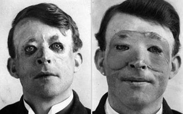  Walter Yeo, người đầu tiên được cấy ghép da và phẫu thuật thẩm mỹ vào năm 1917