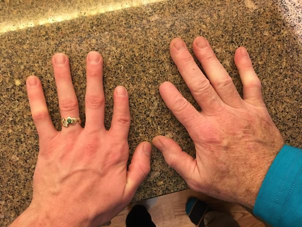   Bàn tay của bố và bàn tay của tôi, di truyền tuyệt đối  