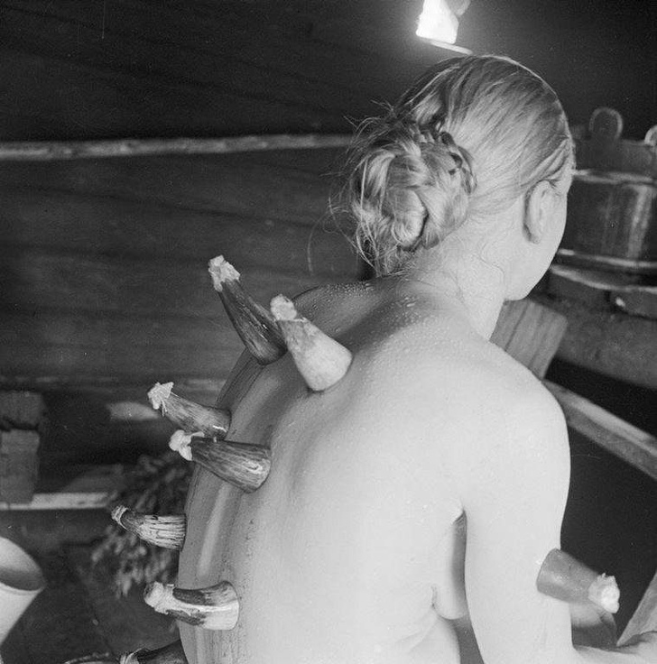 Phương pháp chữa bệnh giác hơi bằng sừng ở Phần Lan, 1935