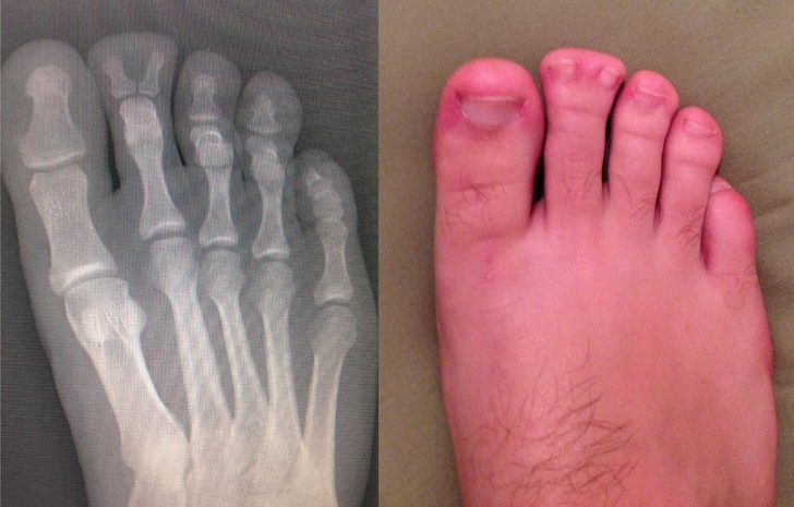 Anh chàng này đã mong đợi được nhìn bức ảnh chụp X-quang bàn chân mình suốt 22 năm qua 