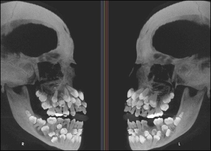 Ảnh chụp X-quang một người bị tật thừa răng