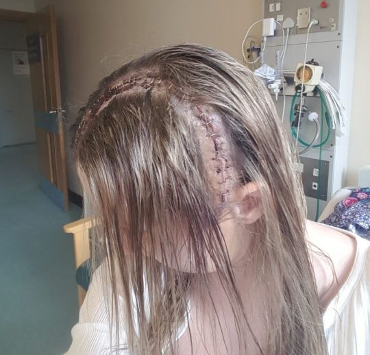 Vết sẹo lớn trên đầu Sarah May sau phẫu thuật não