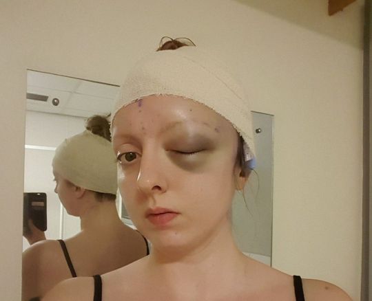 Phần mắt thâm tím của Sarah sau ca phẫu thuật