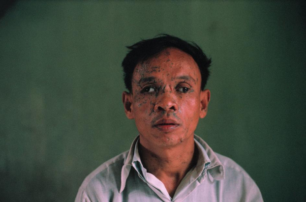   Chân dung một thương binh QĐND Việt Nam, người đã bị thương nặng ở đầu và mù hai mắt trong chiến dịch Tết Mậu Thân 1968.  