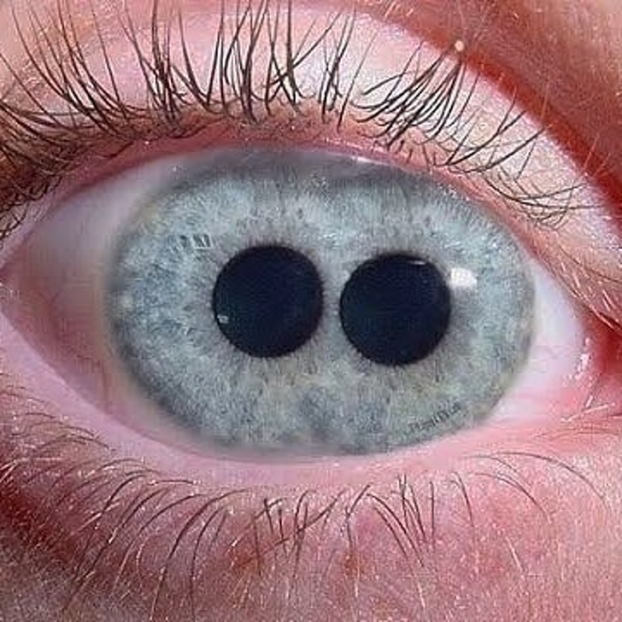   Polycoria là tật nhiều lỗ mống mắt khiến một con mắt có tới hai con ngươi  