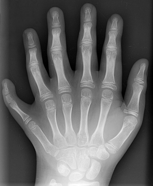   Ảnh chụp X-quang một người bị tật thừa ngón tay  