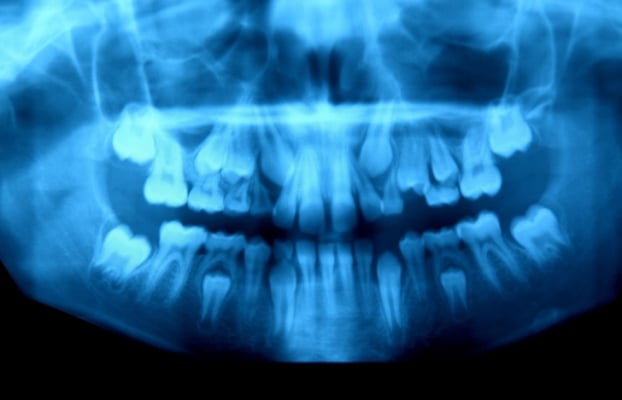   Hàm răng một cậu bé 10 tuổi đang thay răng sữa bằng răng vĩnh viễn  