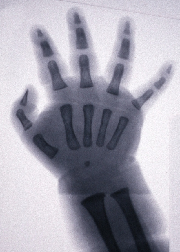   Ảnh chụp X-quang bàn tay một đứa trẻ  