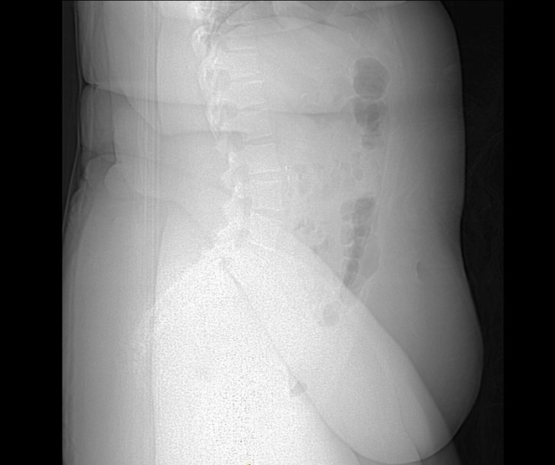   Ảnh chụp X-quang một người béo phì. Lớp mỡ thừa khiến việc quan sát xương bên dưới trở nên khó khăn  
