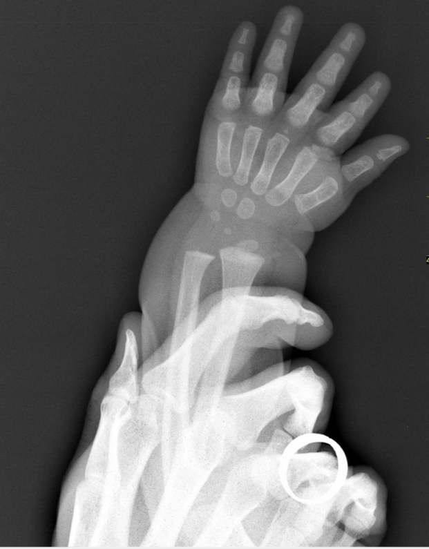   Ảnh chụp X-quang bàn tay một người lớn và bàn tay một đứa trẻ  
