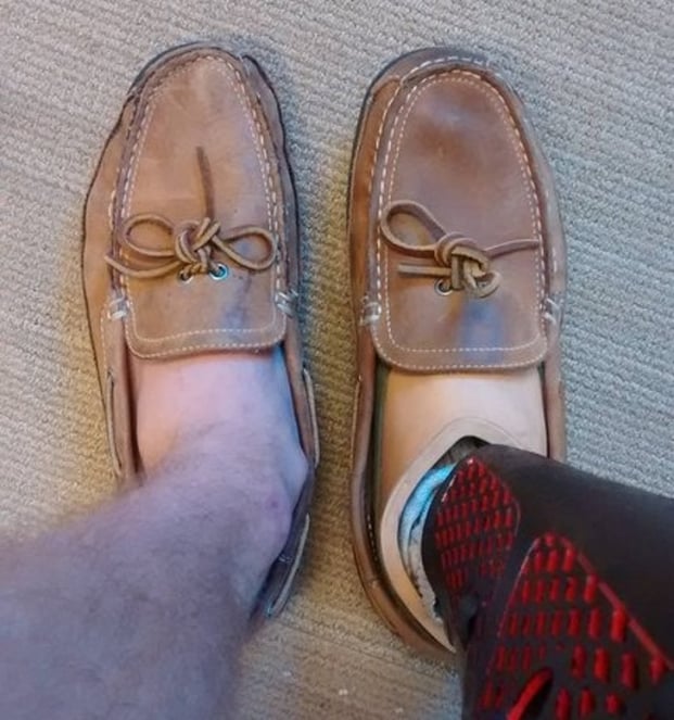   Sự khác biệt giữa hai chiếc giày ở bên chân bình thường và bên chân giả sau 1 năm  