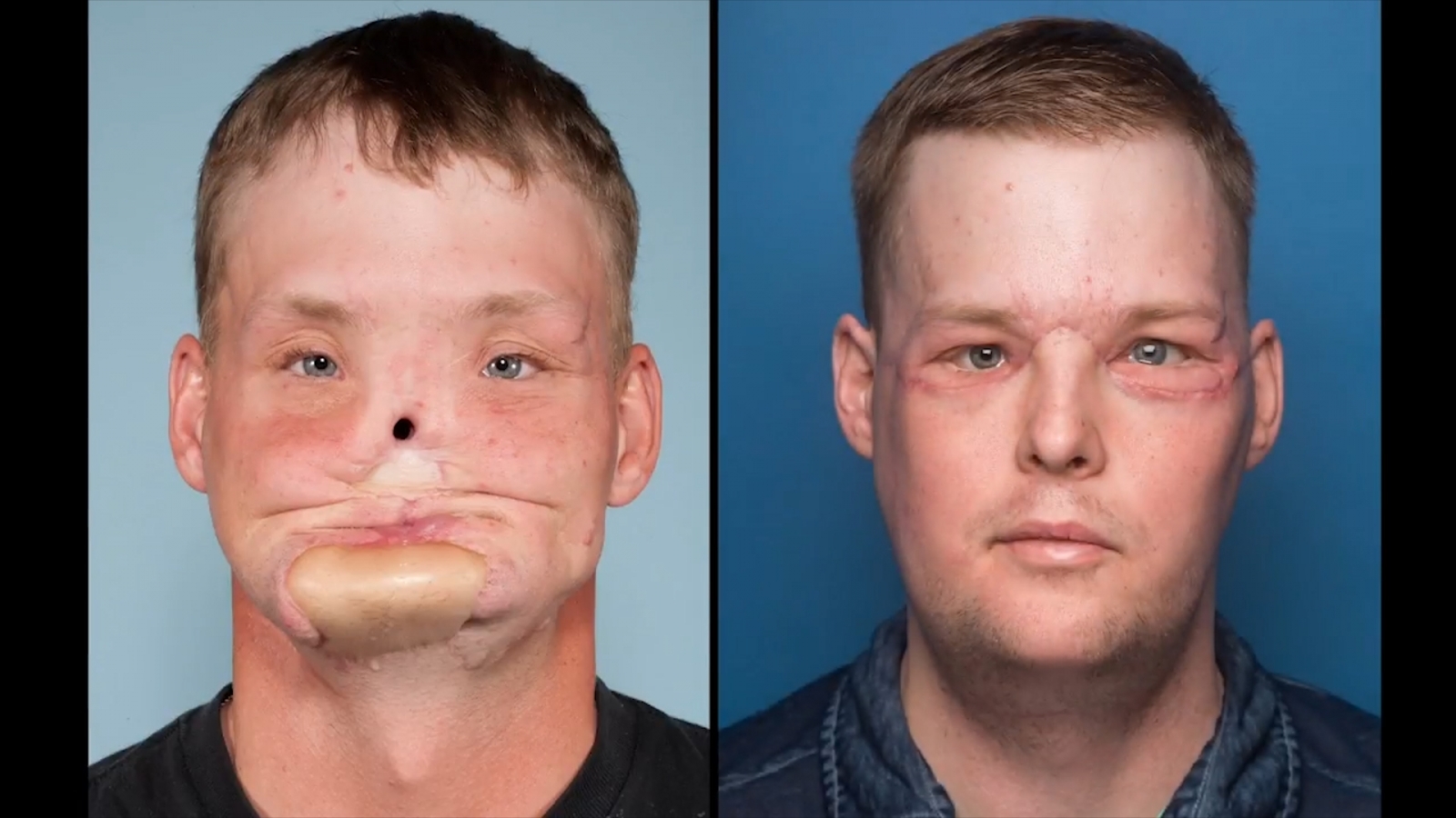 Khuôn mặt trước và sau khi phẫu thuật cấy ghép của anh Sandness - Nguồn: Daily Mail UK