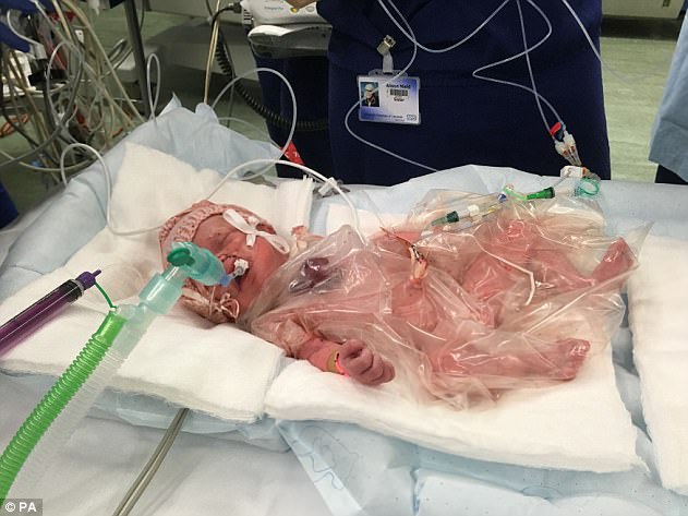 Sau khi được sinh ra, bé Venellope được đặt trong túi nhựa để tránh nhiễm trùng và giữ ẩm cho các tế bào nằm ngoài cơ thể - Nguồn: Daily Mail UK