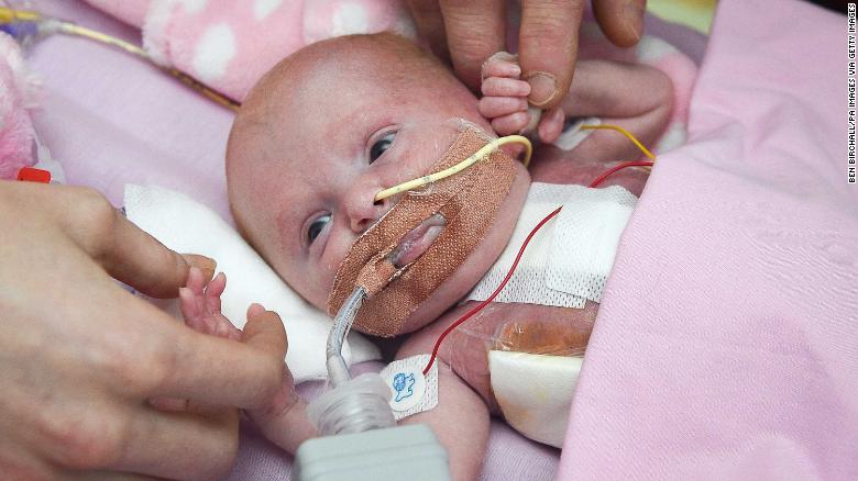 Bé Vanellope Hope Wilkins, em bé may mắn và dũng cảm sóng sót qua cuộc phẫu thuật tái cấu trúc tim - Nguồn: CNN