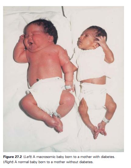 (Bên trái) Em bé có mẹ mắc tiểu đường và (bên phải) em bé được sinh bởi người mẹ không mắc tiểu đường