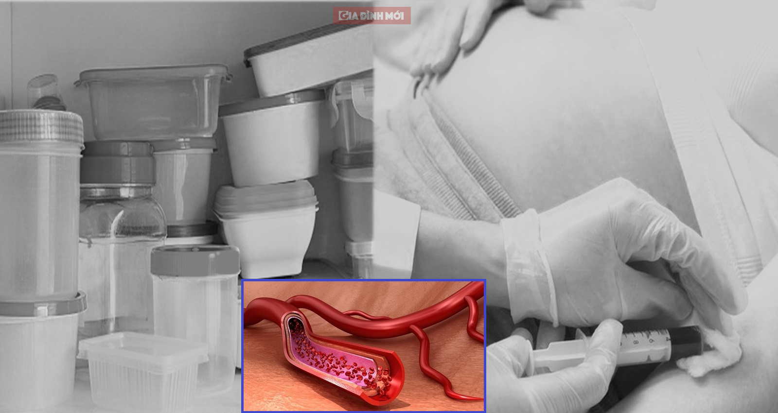 Nghiên cứu: Chất có trong đồ nhựa đựng thực phẩm đã xâm nhập vào máu bà bầu, thai nhi 0