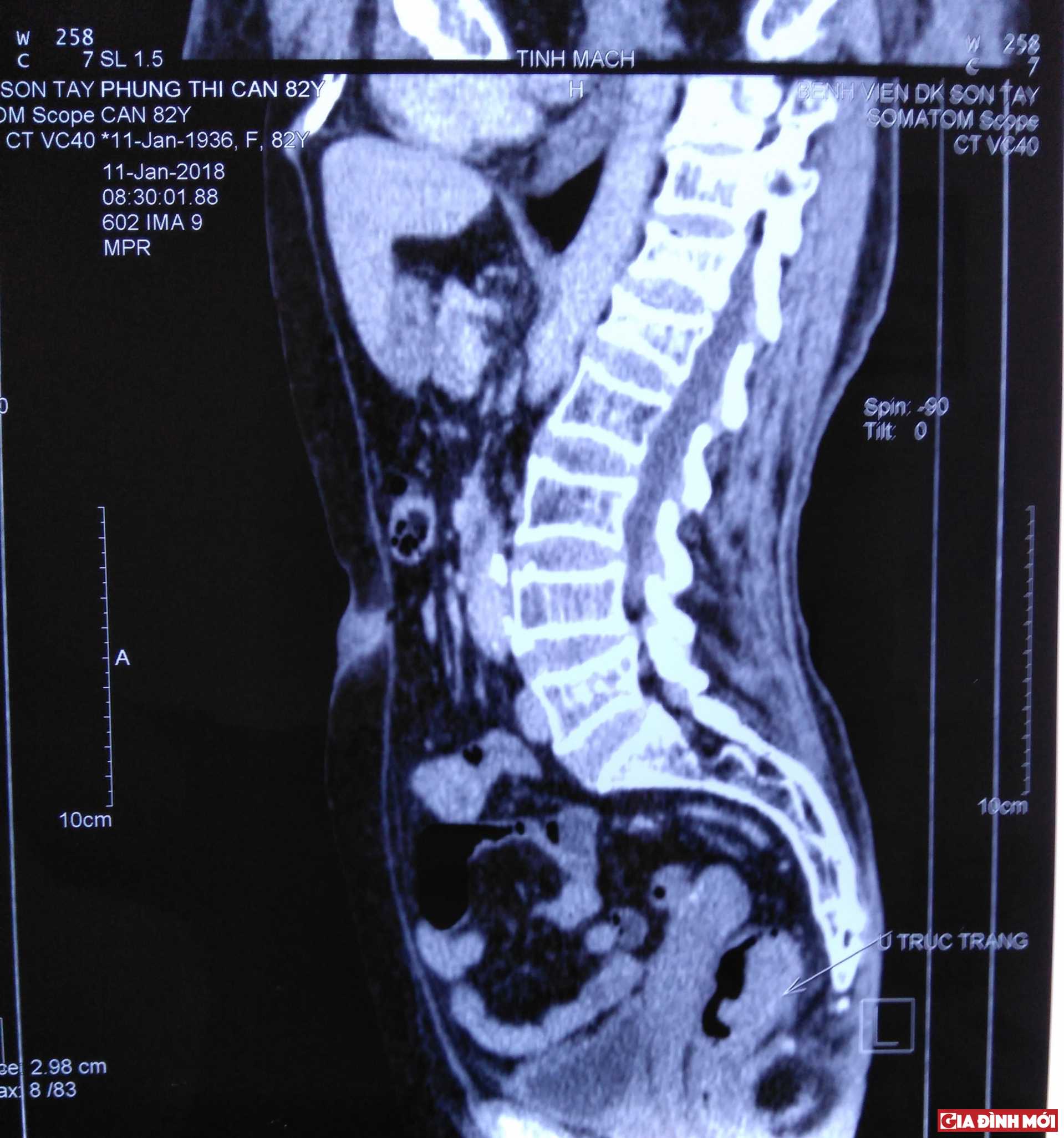 Phim chụp thấy rõ khối u đại – trực tràng trên bệnh nhân Phùng Thị C. 