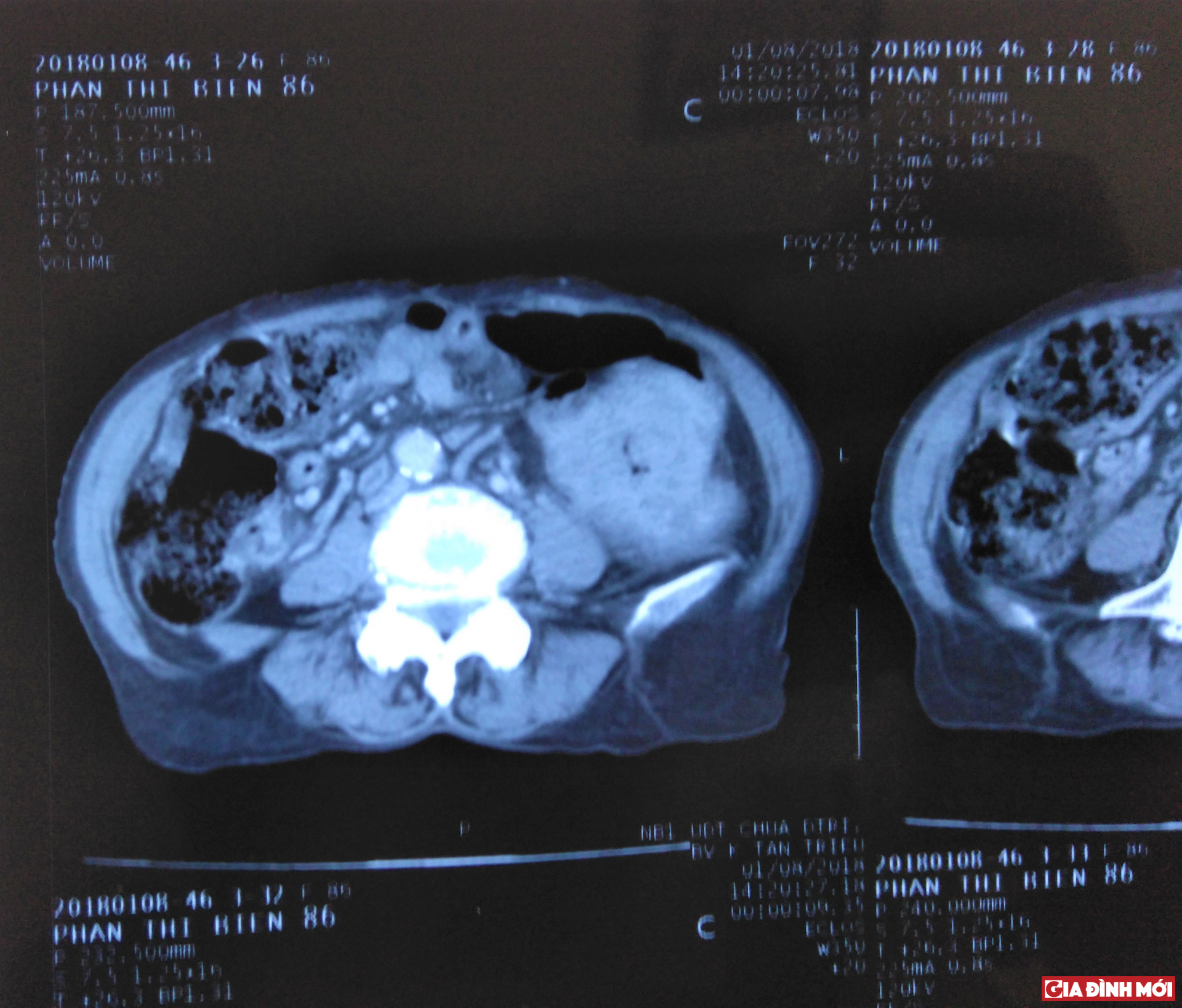 Phim chụp bệnh nhân Phạm Thị B. với khối u đại tràng. 
