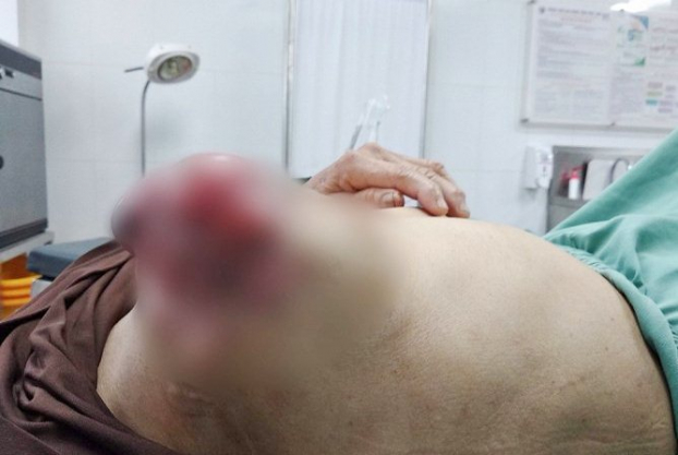   Bệnh nhân bị ung thư vú nhưng tự chữa trị đến khi vùng ngực hoại tử mới đến bệnh viện  