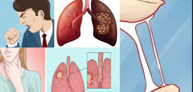   Ung thư phổi không có dấu hiệu đặc hiệu ở giai đoạn sớm nên phát hiện khó.  