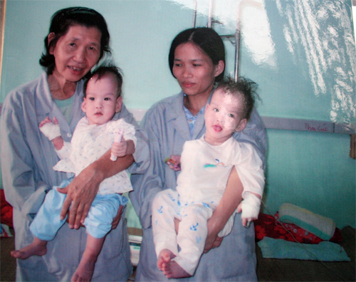 15 năm cặp song sinh tách rời Cúc và An trong ký ức GS Nguyễn Thanh Liêm 4