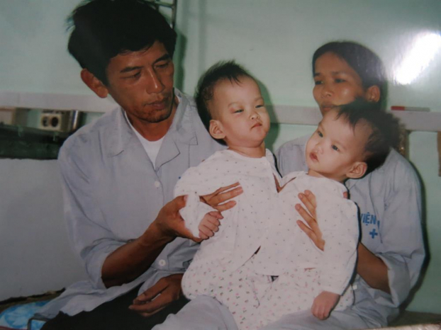 15 năm cặp song sinh tách rời Cúc và An trong ký ức GS Nguyễn Thanh Liêm 1