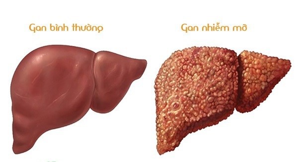 gan nhiem mo nguy en nhan và trieu chung giadinhvietnam (1)