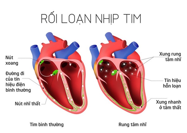 roi loan nhip tim 3