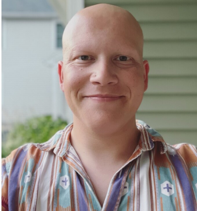 Alopecia Universalis la mot trong nhung chung benh hoi dau nguy hiem nhat