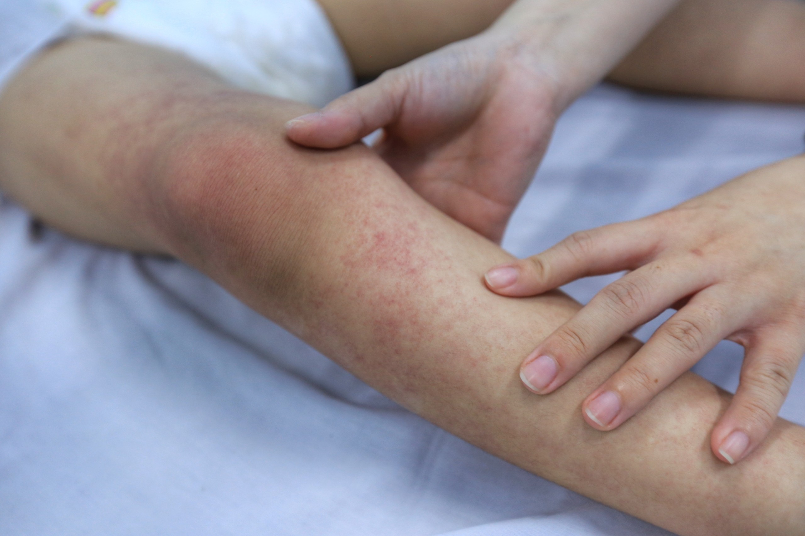 Hà Nội ghi nhận gần 10.000 ca sốt xuất huyết dù chưa đỉnh dịch
