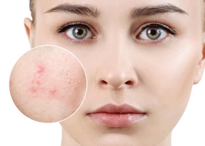 Cách trị mụn ẩn dưới da hiệu quả lên tới 90% ai cũng nên biết