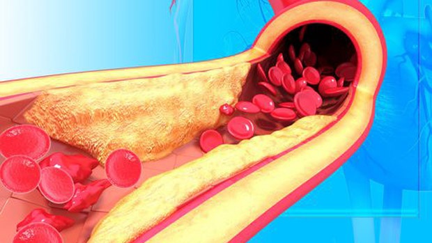 4 triệu chứng trên bàn chân cảnh báo mỡ máu cao