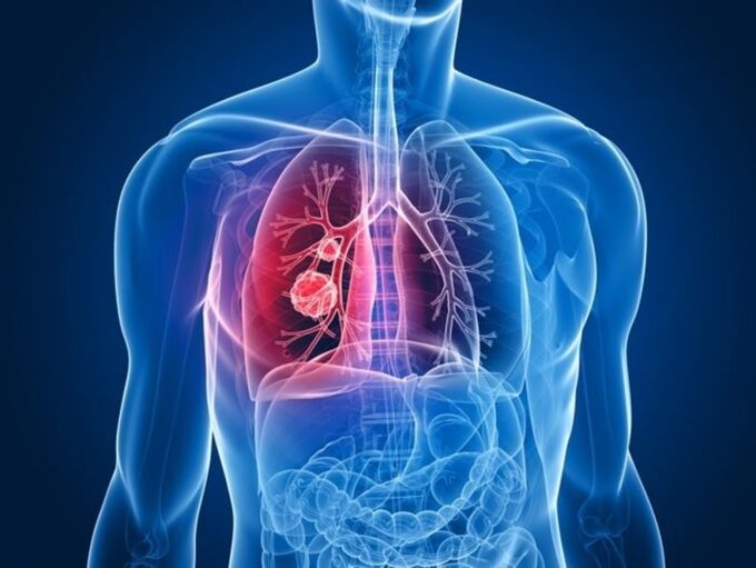 4 dấu hiệu buổi sáng cảnh báo nguy cơ ung thư phổi