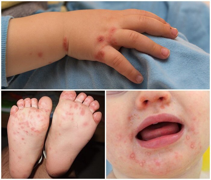 Ca mắc tay chân miệng ở Hà Nội tăng gấp đôi sau 1 tuần với 2 biến chứng
