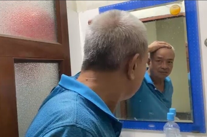 Chấm dứt tự ti vì vảy nến chỉ nhờ uống thảo dược