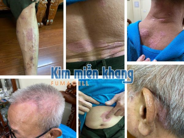 Chấm dứt tự ti vì vảy nến chỉ nhờ uống thảo dược